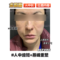 王娟-人中缩短+唇峰重塑 (1)