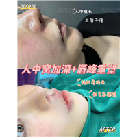 甘丽 人中窝 唇峰 (2)
