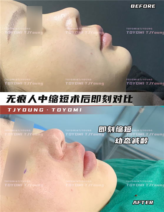 赖兆鑫-双内外下 人中缩短 (3)