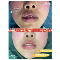 徐佳欢-眼综合+唇改薄
