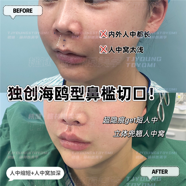 吴妍婷-人中缩短人中窝眉