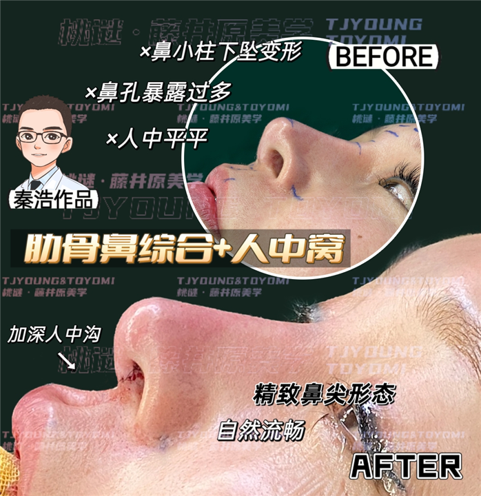 张翠红肋骨鼻