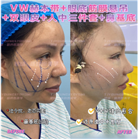 6马运超-赫本带鼻基底双眼皮眼底筋膜人中三件套
