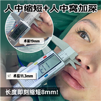 吴妍婷-人中缩短人中窝眉3