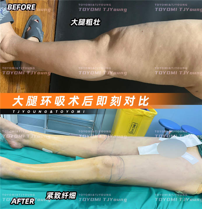 陈亚丹--大腿环吸 丰臀 (1)