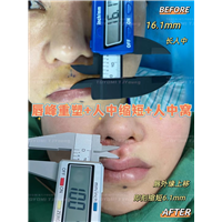 吴青-唇峰重塑+人中缩短+人中窝 (4)