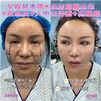 5马运超-赫本带鼻基底双眼皮眼底筋膜人中三件套