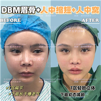 吴妍婷-人中缩短人中窝眉4