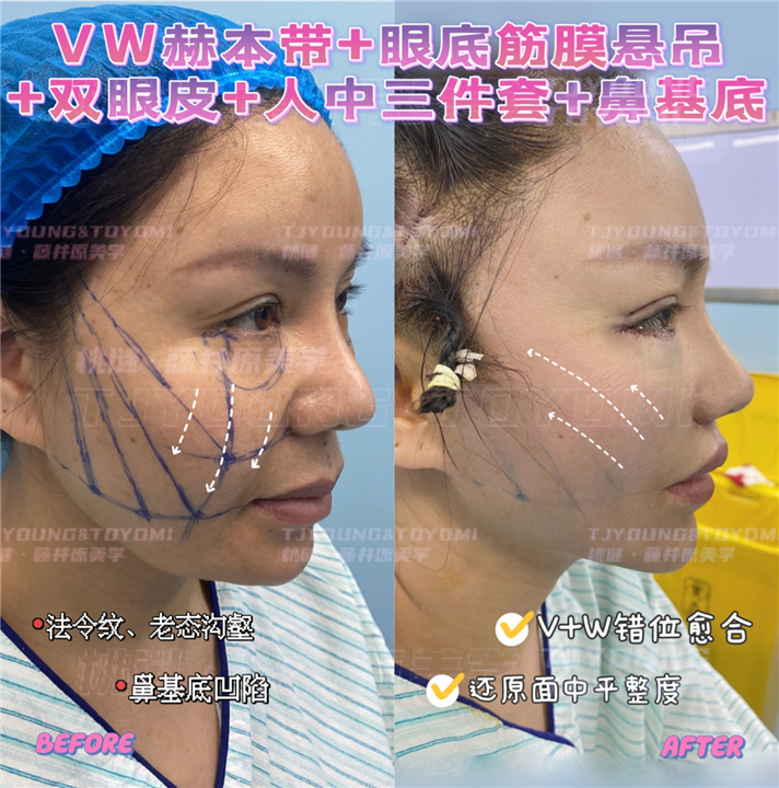 6马运超-赫本带鼻基底双眼皮眼底筋膜人中三件套