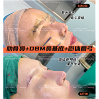 阿迪拉-肋骨鼻+鼻基底+眉gong (3)