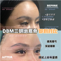 吴妍婷-人中缩短人中窝眉5