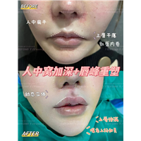 甘丽 人中窝 唇峰 (3)