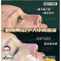 张翠红肋骨鼻3