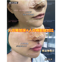 李玲玲-人中窝人中脊