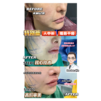 王娟-人中缩短+唇峰重塑 (6)