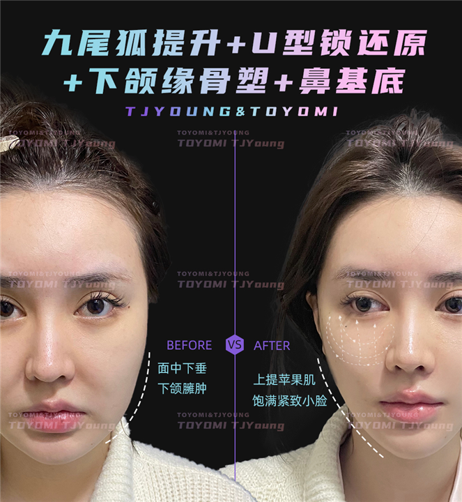罗子璇--九尾狐 U型锁 下颌缘 鼻基底 (3)