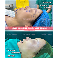 汤霖 肋骨鼻➕鼻基底➕自体脂肪填充 (1)