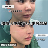 吴妍婷-人中缩短人中窝眉2