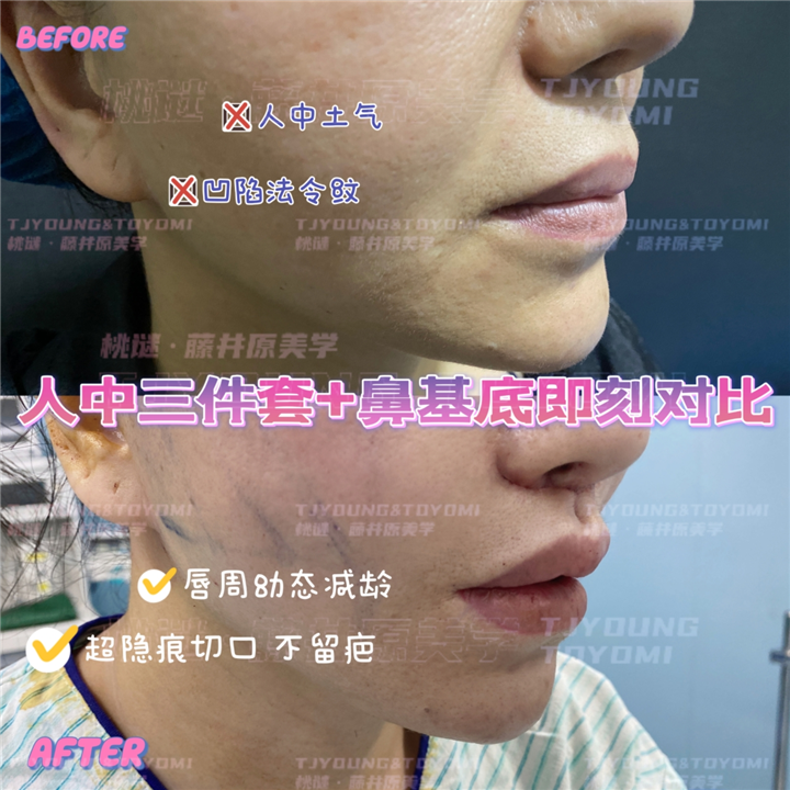 2马运超-赫本带鼻基底双眼皮眼底筋膜人中三件套