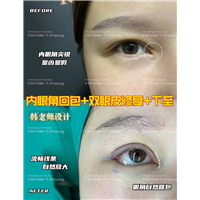 赖兆鑫-双内外下 人中缩短 (4)