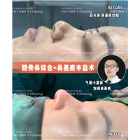 王晶-肋骨鼻+鼻基底 (3)
