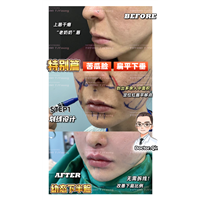 王娟-人中缩短+唇峰重塑 (7)