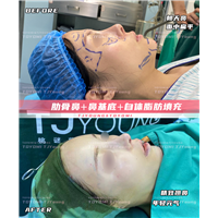 汤霖 肋骨鼻➕鼻基底➕自体脂肪填充 (2)