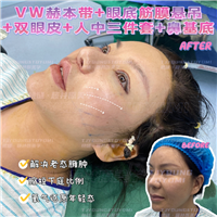 4马运超-赫本带鼻基底双眼皮眼底筋膜人中三件套