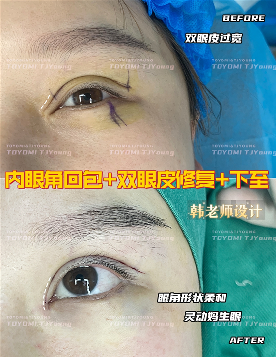 赖兆鑫-双内外下 人中缩短 (5)