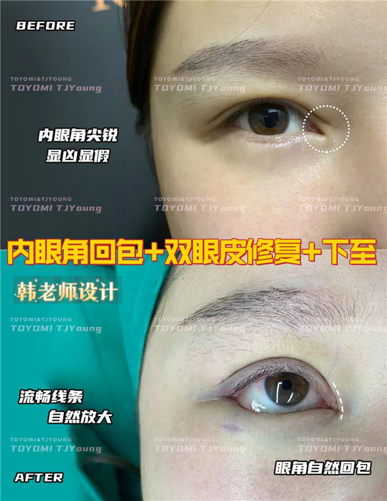 赖兆鑫-双内外下 人中缩短 (4)
