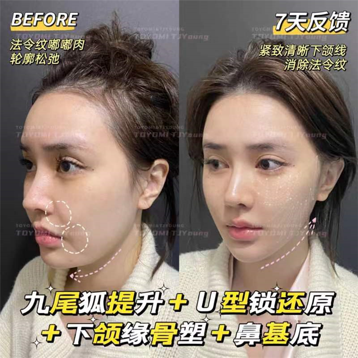 罗子琁-九尾狐+U型锁+鼻基底 (1)