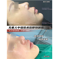 赖兆鑫-双内外下 人中缩短 (3)