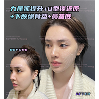 罗子璇--九尾狐 U型锁 下颌缘 鼻基底 (
