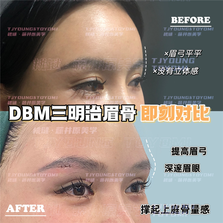 吴妍婷-人中缩短人中窝眉5