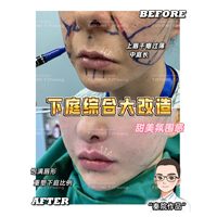 王娟-人中缩短+唇峰重塑 (3)