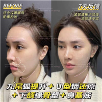 罗子琁-九尾狐+U型锁+鼻基底 (1)