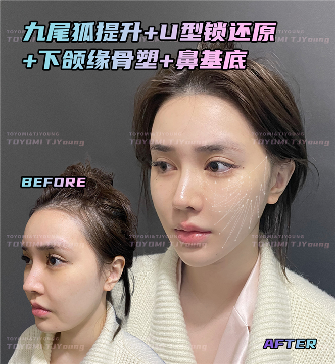 罗子璇--九尾狐 U型锁 下颌缘 鼻基底 (