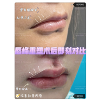 吴青-唇峰重塑+人中缩短+人中窝 (2)