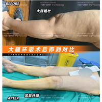 陈亚丹--大腿环吸 丰臀 (1)