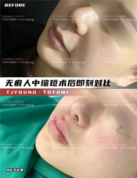 赖兆鑫-双内外下 人中缩短 (1)