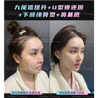 罗子璇--九尾狐 U型锁 下颌缘 鼻基底 (2)