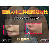 宋平平-人中三件套1