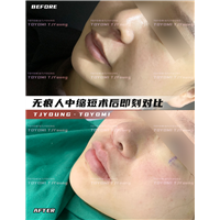 赖兆鑫-双内外下 人中缩短 (1)