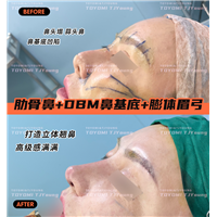 阿迪拉-肋骨鼻+鼻基底+眉gong(2)