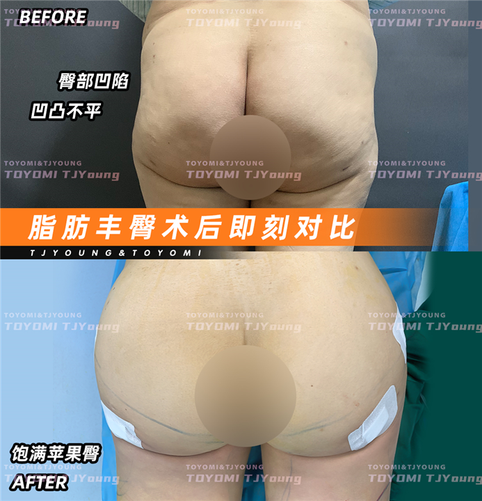 陈亚丹--大腿环吸 丰臀 (2)