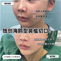 吴妍婷-人中缩短人中窝眉