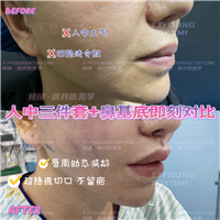 2马运超-赫本带鼻基底双眼皮眼底筋膜人中三件套