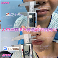 3马运超-赫本带鼻基底双眼皮眼底筋膜人中三件套