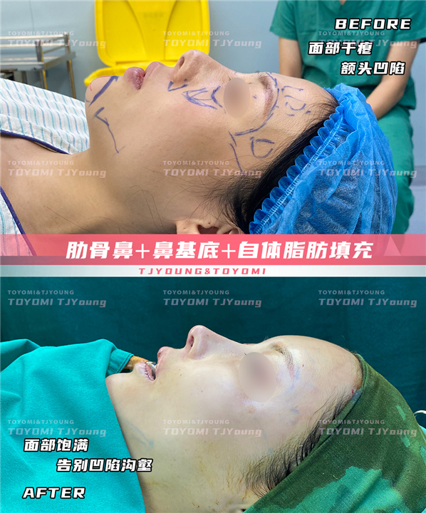汤霖 肋骨鼻➕鼻基底➕自体脂肪填充 (1)