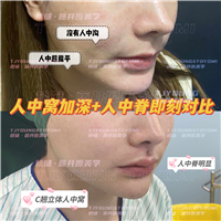 黄菊-人中窝人中脊3